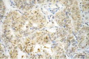 Immunohistochemistry was performed on paraffin-embedded human endometrial carcinoma using annexin A1 antibody (ABIN7797612), 1:200).