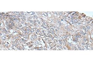 Immunohistochemistry of paraffin-embedded Human lung cancer tissue using ETFB Polyclonal Antibody at dilution of 1:40(x200) (ETFB antibody)
