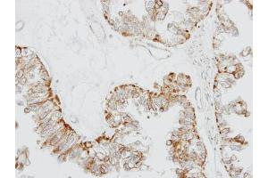 IHC-P Image Immunohistochemical analysis of paraffin-embedded OVCA xenograft, using GPR164, antibody at 1:100 dilution. (OR51E1 antibody)
