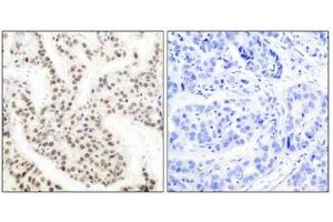 Immunohistochemical analysis of paraffin-embedded human breast carcinoma tissue using Elk-1 (phospho-Thr417) antibody. (ELK1 antibody  (pThr417))