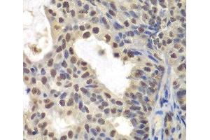 Immunohistochemistry of paraffin-embedded Human oophoroma using CENPC Polyclonal Antibody at dilution of 1:200 (40x lens). (Centromere Protein C Pseudogene 1 (CENPCP1) antibody)