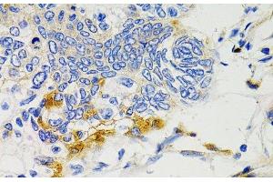 Immunohistochemistry of paraffin-embedded Human gastric cancer using PTPN11 Polyclonal Antibody at dilution of 1:100 (40x lens). (PTPN11 antibody)