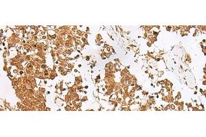 Immunohistochemistry of paraffin-embedded Human lung cancer tissue using SCRN2 Polyclonal Antibody at dilution of 1:60(x200) (SCRN2 antibody)