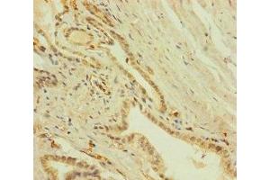 Immunohistochemistry of paraffin-embedded human prostate cancer using ABIN7151756 at dilution of 1:100 (ZNF71 antibody  (AA 101-300))