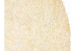 ABIN6261669 and ABIN6273242 at 1/100 staining human glioblastoma by IHC-P. (FAM65B antibody  (Internal Region))