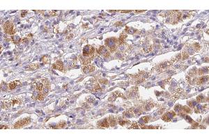 ABIN6272580 at 1/100 staining Human liver cancer tissue by IHC-P.