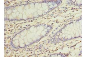 Immunohistochemistry of paraffin-embedded human colon cancer using ABIN7168469 at dilution of 1:100 (RUSC1 antibody  (AA 231-433))