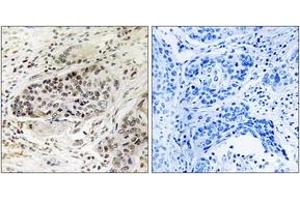 Immunohistochemistry analysis of paraffin-embedded human lung carcinoma tissue, using APBA2 Antibody. (APBA2 antibody  (AA 371-420))