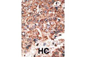 Formalin-fixed and paraffin-embedded human hepatocellular carcinoma tissue reacted with MMP20 polyclonal antibody  , which was peroxidase-conjugated to the secondary antibody, followed by DAB staining. (MMP20 antibody  (Internal Region))