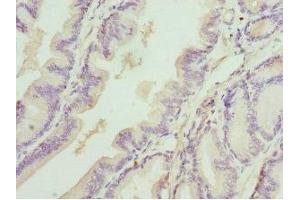 Immunohistochemistry of paraffin-embedded human prostate cancer using ABIN7149547 at dilution of 1:100 (DEDD antibody  (AA 1-318))