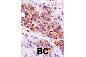 Formalin-fixed and paraffin-embedded human cancer tissue reacted with UBE2B polyclonal antibody  , which was peroxidase-conjugated to the secondary antibody, followed by DAB staining. (UBE2B antibody  (C-Term))