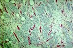 Carcinoma of the breast (MAb CE6, PECAM-1) (CD31 antibody)
