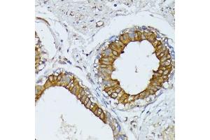 Immunohistochemistry of paraffin-embedded human mammary cancer using WNT1 antibody (ABIN1683291, ABIN3016105, ABIN3016107 and ABIN6219551) at dilution of 1:100 (40x lens).
