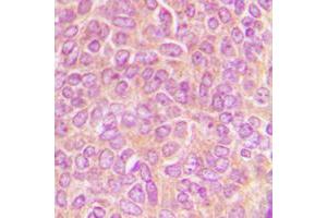 Immunohistochemical analysis of CLASP1 staining in human breast cancer formalin fixed paraffin embedded tissue section. (CLASP1 antibody  (C-Term))