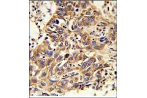 Immunohistochemistry: AP17923PU-N CAT Antibody staining of Formalin-Fixed, Paraffin-Embedded Human Lung carcinoma. (Catalase antibody  (AA 159-188))