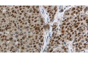 Immunohistochemistry of paraffin-embedded Human liver cancer using MCM3 Polyclonal Antibody at dilution of 1:30 (MCM3 antibody)