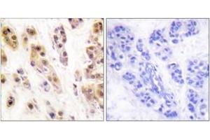 Immunohistochemistry analysis of paraffin-embedded human breast carcinoma, using SSB (Phospho-Ser366) Antibody. (SSB antibody  (pSer366))