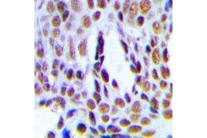 Immunohistochemical analysis of INTS6 staining in human breast cancer formalin fixed paraffin embedded tissue section. (INTS6 antibody)