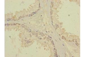 Immunohistochemistry of paraffin-embedded human prostate cancer using ABIN7171903 at dilution of 1:100 (TTC12 antibody  (AA 1-260))