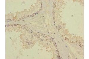 Immunohistochemistry of paraffin-embedded human prostate cancer using ABIN7171903 at dilution of 1:100 (TTC12 antibody  (AA 1-260))