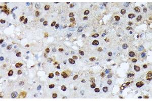 Immunohistochemistry of paraffin-embedded Human liver cancer using Phospho-ATF2(T69/T71) Polyclonal Antibody at dilution of 1:100 (40x lens). (ATF2 antibody  (pThr69, pThr71))