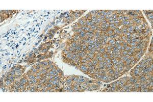 Immunohistochemistry of paraffin-embedded Human liver cancer tissue using SLC16A1 Polyclonal Antibody at dilution 1:50 (SLC16A1 antibody)