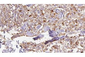 ABIN6277005 at 1/100 staining Human Melanoma tissue by IHC-P. (APCS antibody  (Internal Region))