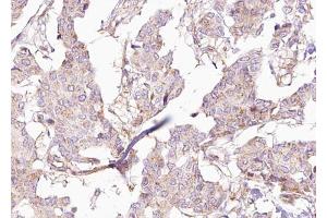 ABIN6273033 at 1/100 staining Human breast cancer tissue by IHC-P. (BCS1L antibody  (Internal Region))