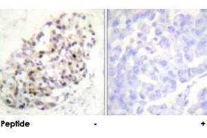 Immunohistochemical analysis of paraffin-embedded human breast carcinoma tissue using KIF20A polyclonal antibody . (KIF20A antibody)