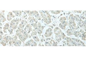 Immunohistochemistry of paraffin-embedded Human gastric cancer tissue using C8orf4 Polyclonal Antibody at dilution of 1:55(x200) (C8orf4 antibody)