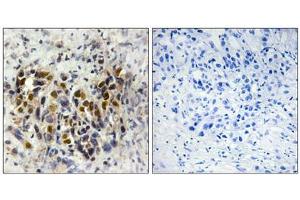 Immunohistochemistry analysis of paraffin-embedded human breast carcinoma tissue, using IRX3 antibody. (IRX3 antibody  (Internal Region))