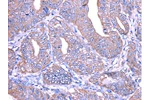 The image on the left is immunohistochemistry of paraffin-embedded Human esophagus cancer tissue using ABIN7128033(THAP6 Antibody) at dilution 1/25, on the right is treated with fusion protein. (THAP6 antibody)