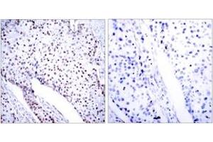 Immunohistochemistry analysis of paraffin-embedded human breast carcinoma tissue, using STAT3 (Ab-705) Antibody. (STAT3 antibody  (AA 672-721))