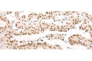 Immunohistochemistry of paraffin-embedded Human liver cancer tissue using VPS51 Polyclonal Antibody at dilution of 1:65(x200)