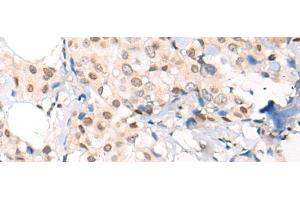 Immunohistochemistry of paraffin-embedded Human breast cancer tissue using VPS51 Polyclonal Antibody at dilution of 1:65(x200)