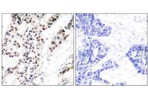 Immunohistochemical analysis of paraffin- embedded human breast carcinoma tissue using Estrogen Receptor-α (phospho-Ser106) antibody (E011071). (Estrogen Receptor alpha antibody  (pSer106))