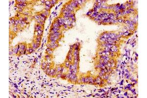 IHC image of ABIN7169929 diluted at 1:300 and staining in paraffin-embedded human endometrial cancer performed on a Leica BondTM system. (SCN9A antibody  (AA 1849-1988))