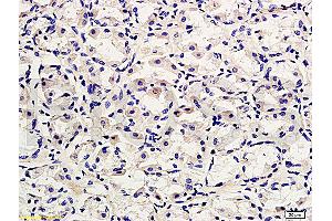 Formalin-fixed and paraffin embedded human gastric adenocarcinoma labeled with Rabbit Anti-CD45/B220 Polyclonal Antibody, Unconjugated (ABIN669606) at 1:200 followed by conjugation to the secondary antibody and DAB staining.
