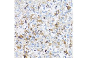 Immunohistochemistry of paraffin-embedded human lung cancer using ACTR2 antibody. (ACTR2 antibody)