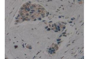 IHC-P analysis of Human Breast Cancer Tissue, with DAB staining. (Cytokeratin 1 antibody  (AA 487-644))