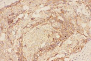 Anti-Eotaxin 3 Picoband antibody,  IHC(P): Human Mammary Cancer Tissue (CCL26 antibody  (AA 24-94))
