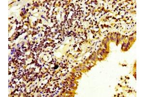 IHC image of ABIN7150781 diluted at 1:200 and staining in paraffin-embedded human lung cancer performed on a Leica BondTM system. (DUSP6 antibody  (AA 100-206))