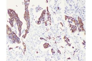 IHC analysis of Cytokeratin 8 using anti-Cytokeratin 8 antibody (ABIN5518853). (KRT8 antibody  (AA 107-325))