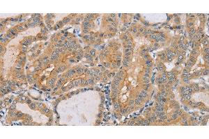 Immunohistochemistry of paraffin-embedded Human thyroid cancer tissue using PTPN4 Polyclonal Antibody at dilution 1:40 (PTPN4 antibody)