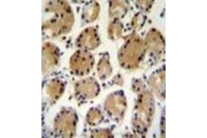 Formalin fixed and paraffin embedded human stomach carcinoma reacted with FAT10 Antibody (C-term) followed by peroxidase conjugation of the secondary antibody and DAB staining. (UBD antibody  (C-Term))