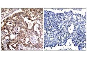 Immunohistochemical analysis of paraffin- embedded human breast carcinoma tissue, using SEK1/MKK4 (Ab-80) antibody (E021132). (MAP2K4 antibody)
