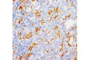 Anti-MPO antibody, IHC(P): Human Liver Cancer Tissue (Myeloperoxidase antibody  (C-Term))