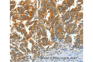 Immunohistochemistry of Human gastric cancer using ASNS Polyclonal Antibody at dilution of 1:60 (Asparagine Synthetase antibody)