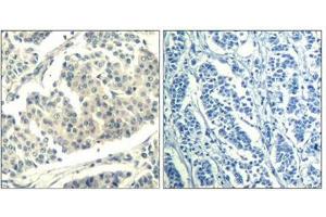 Immunohistochemical analysis of paraffin-embedded human breast carcinoma tissue using ABL1/2(Phospho-Tyr393/439) Antibody(left) or the same antibody preincubated with blocking peptide(right). (ABL1/2 antibody  (pTyr393, pTyr439))