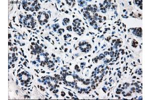 Immunohistochemical staining of paraffin-embedded breast tissue using anti-TTLL12 mouse monoclonal antibody. (TTLL12 antibody)